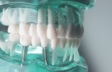השתלת שינייםהשתלות שיניים לחולים בסוכרת