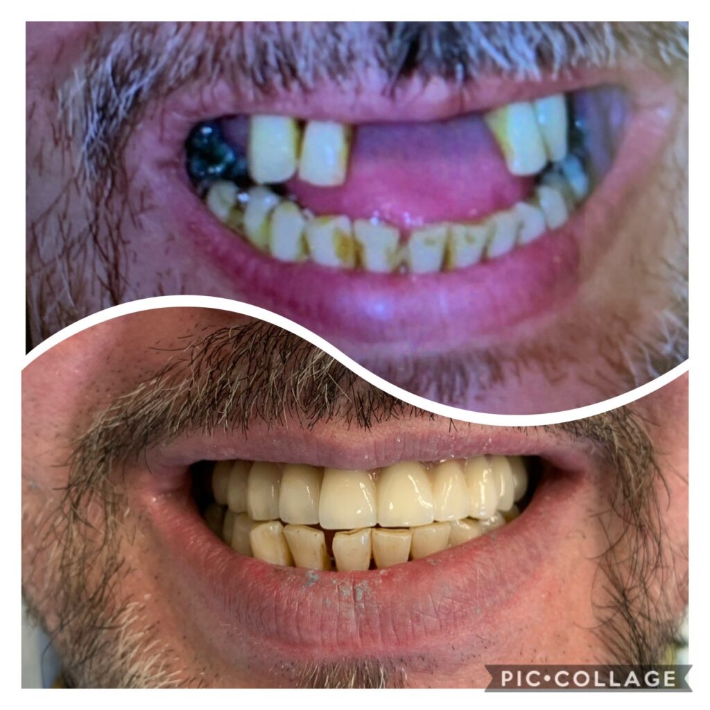 השתלות שיניים לפני אחרי - 6